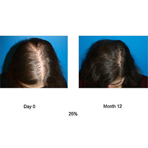 Hair Loss - Shiraz Cosmetic and Medical Clinic - skin specialists