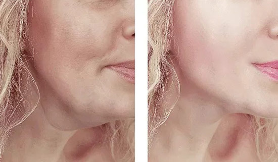 PDO Thread Lift Results