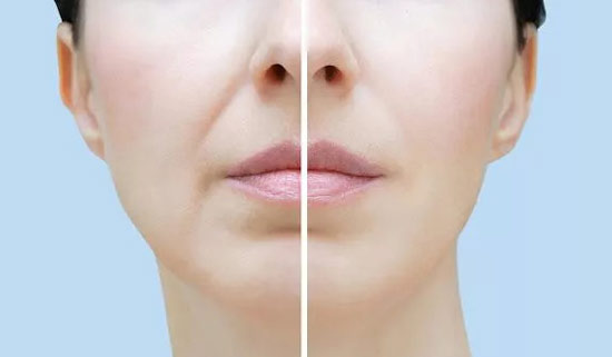 PDO Thread Lift Results