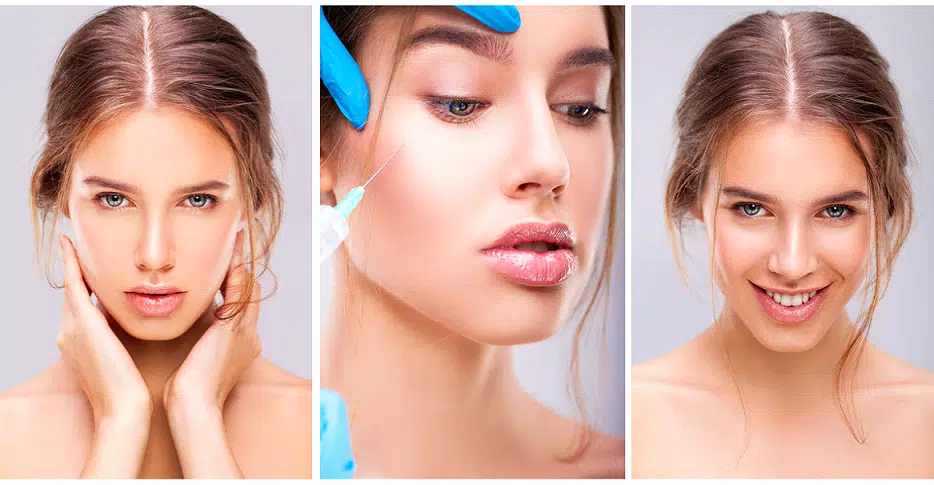 cheek augmentation