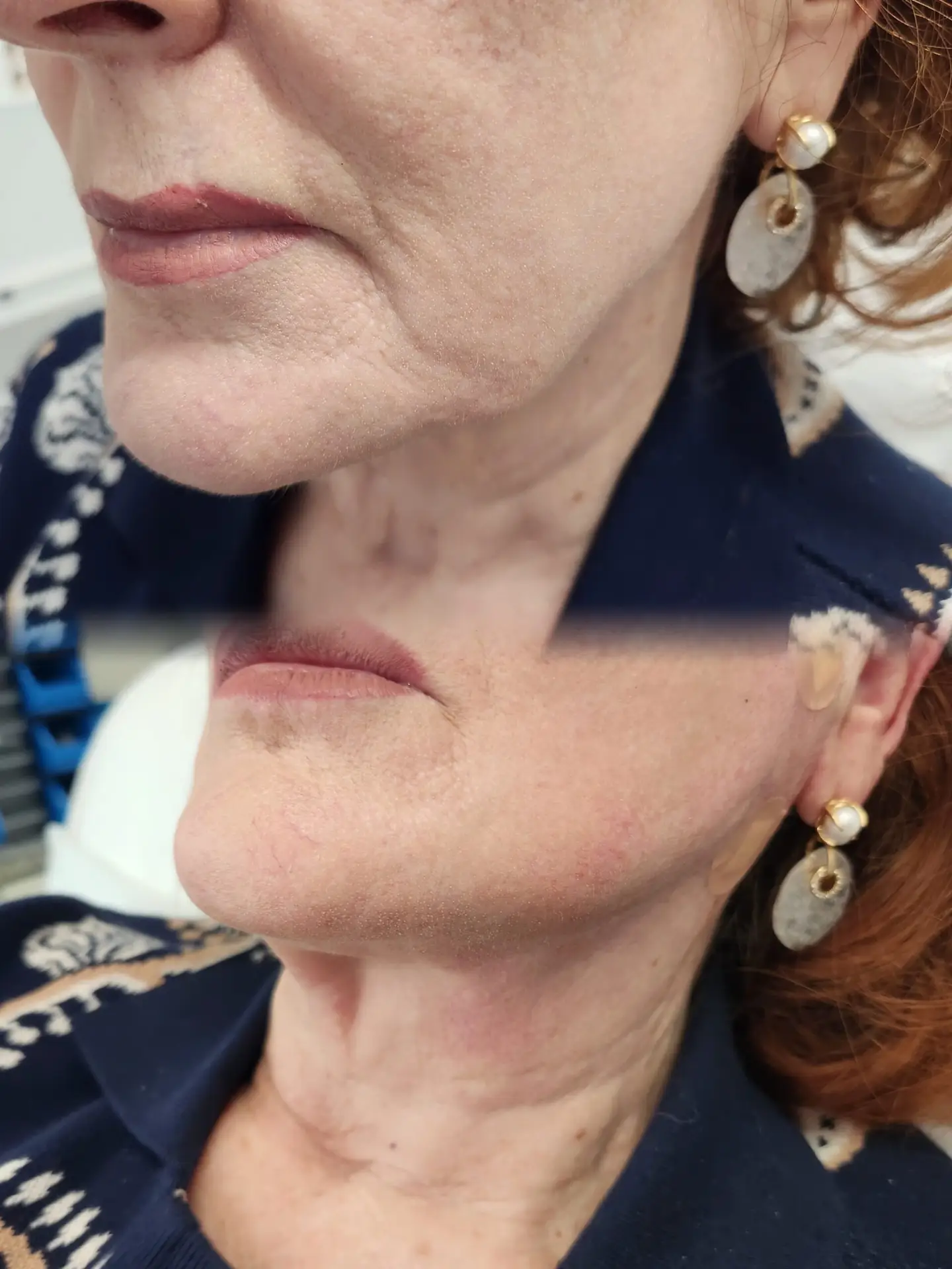 PDO Lifting Thread .Lower and Mid Face