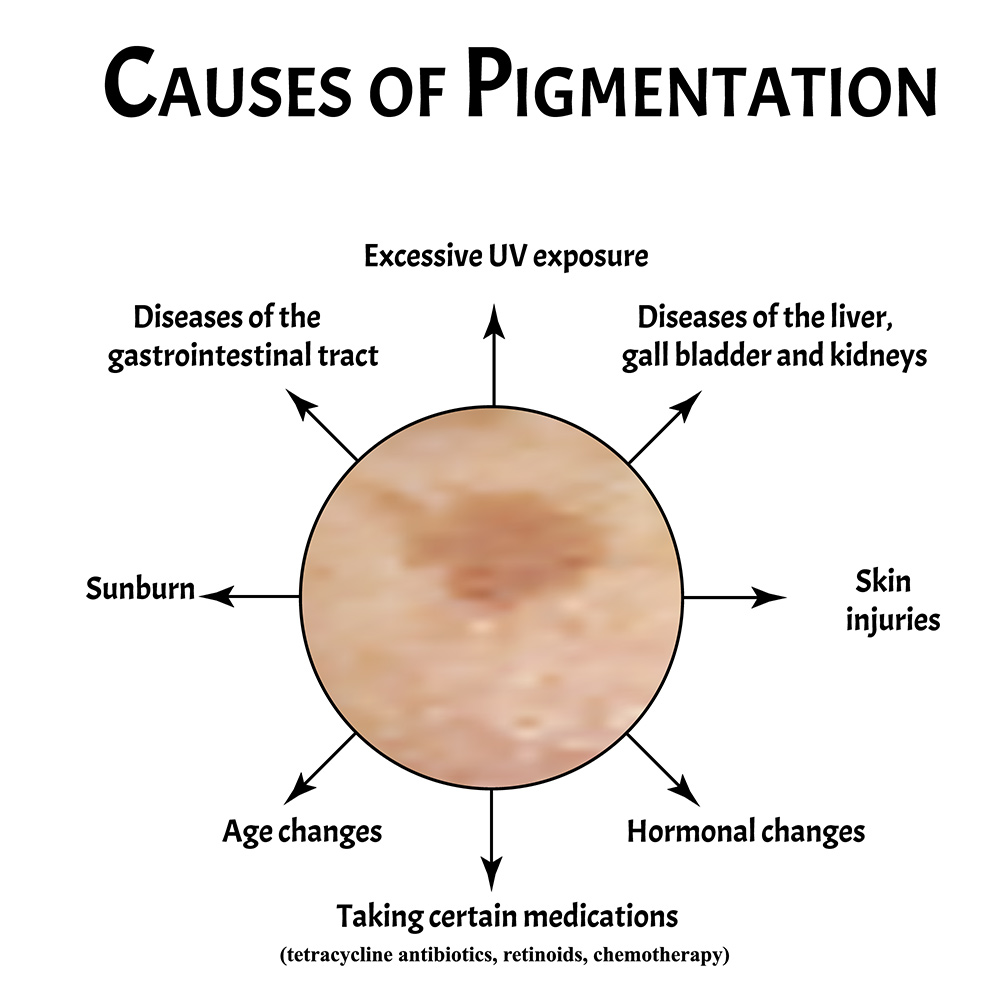 laser pigmentation removal sydney