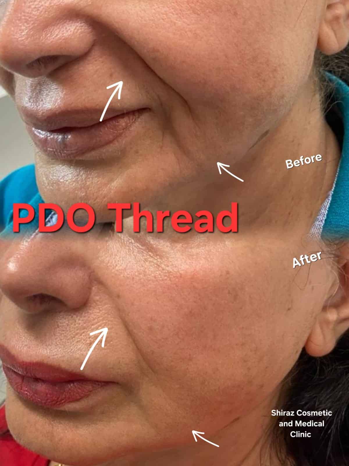 pdo thread lift