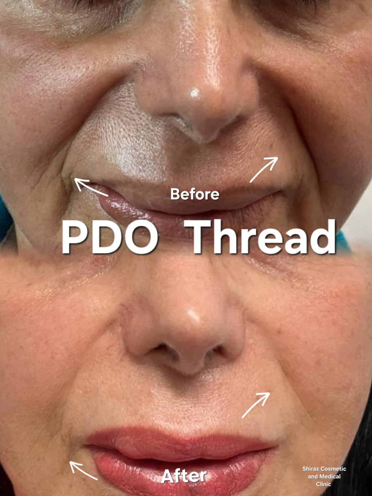 pdo thread lift