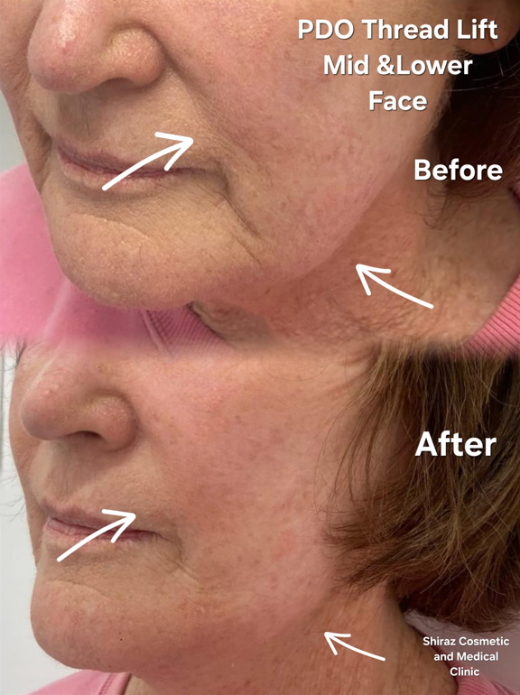 Inside The PDO Thread Lift Procedure