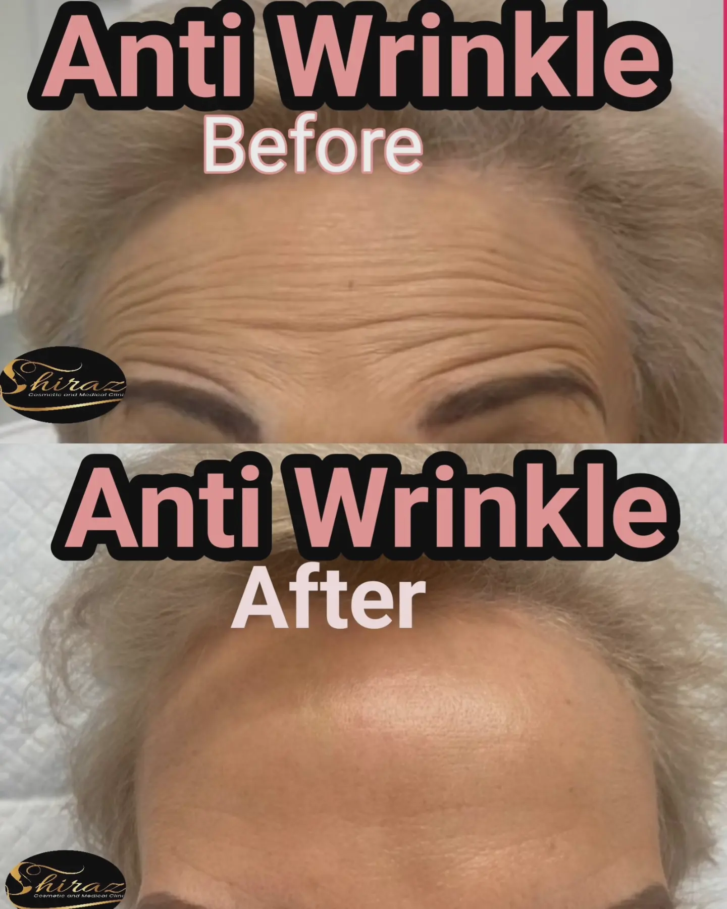 Botox