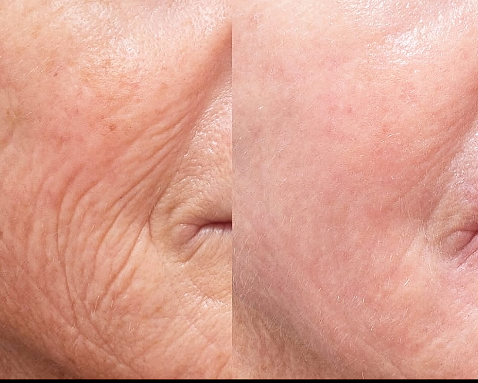 Biro Remodelling - Skin Rejuvanation