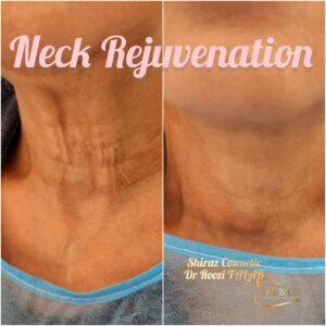 Neck Rejuvanation